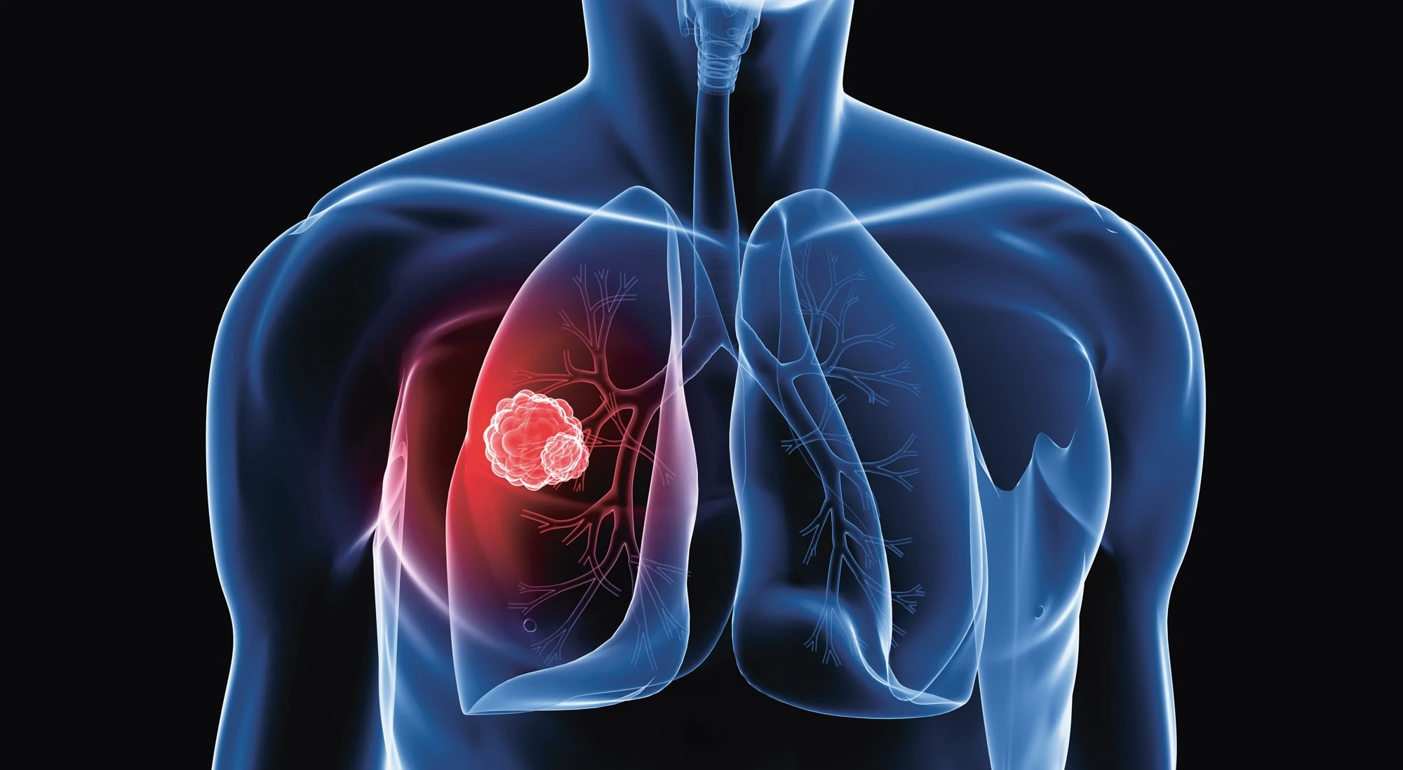 Animiertes-Röntgenbild-eines-Lungenkarzinoms-Rigontec